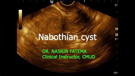 Nabothian Cyst In Cervix Ii Dr Nasrin Fatema Ii Real Time Ultrasound Ii