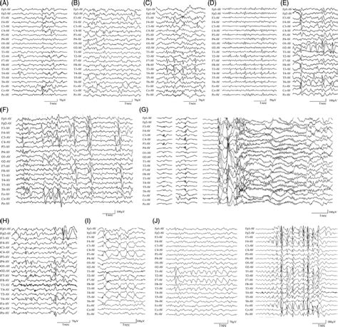 Representative Eeg Recordings Of The Patients With Hcfc1 Variants A