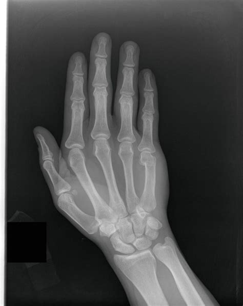 Clinical Cases And Images Boxer S Fracture