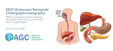 Ercp Endoscopic Retrograde Cholangio Pancreatography Dr Amit