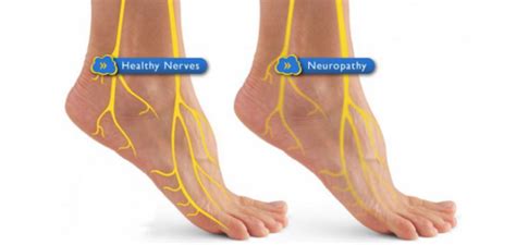 Resources for neuropathy in feet. 6 Natural Solutions for Diabetic Neuropathy