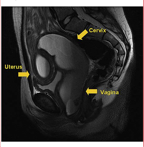 figure 1 from concomitant resorptive defects of the reproductive tract a uterocervicovaginal
