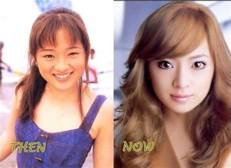Japanese Plastic Surgery Before After