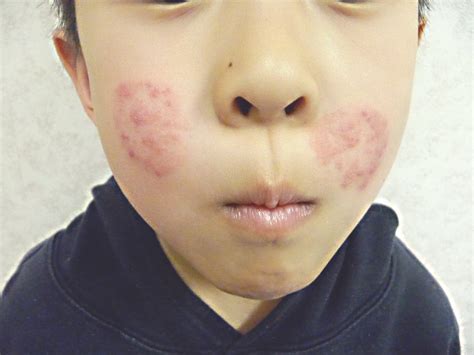 Boy With Pruritic Rash On Both Cheeks Consultant360