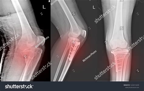 Xray Knee Joint Fracture Proximal Tibia Stock Photo 1224214249