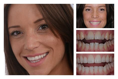 Invisalign Smile Design By Ash