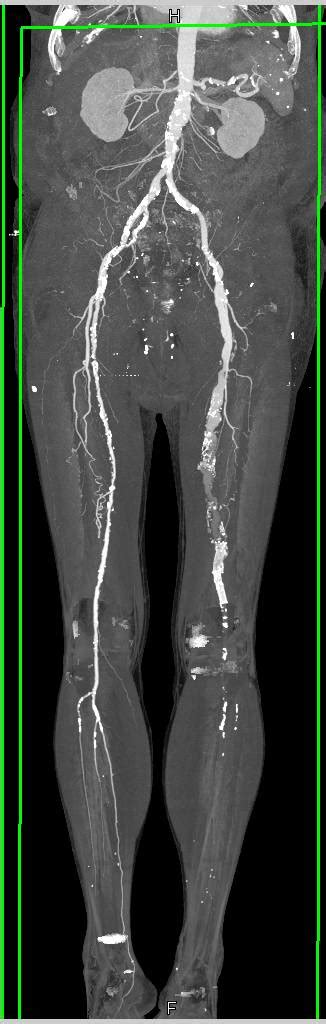 Cta Runoff With Pvd And Stenosis With Occlusion Of Left Popliteal