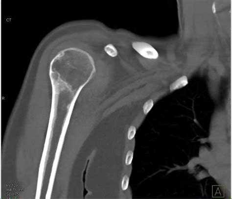 Aneurysmal Bone Cyst Of The Scapula Musculoskeletal Case Studies