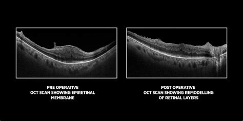 Epiretinal Membrane Symptoms Causes And Treatment