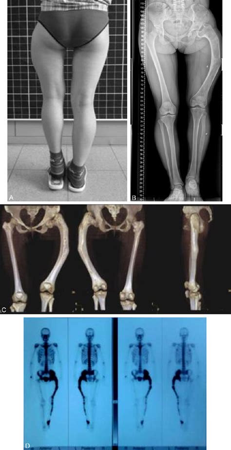 Figure 3 From Double Level Osteotomy And One Stage Reconstruction With