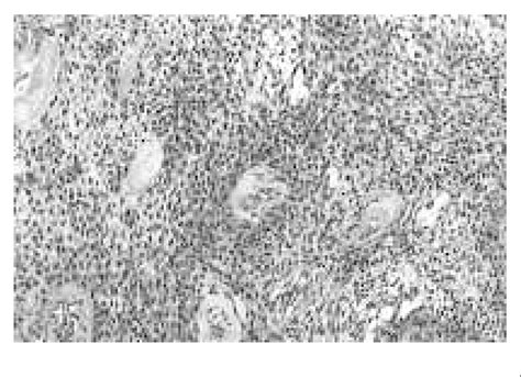 Myoepithelioma Of Minor Salivary Gland Of Cheek Tumour Is Composed Of