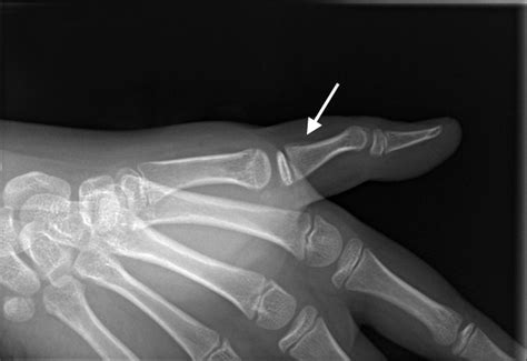 Thumb Proximal Phalanx Fracture Pediatric Hand Surgery Resource