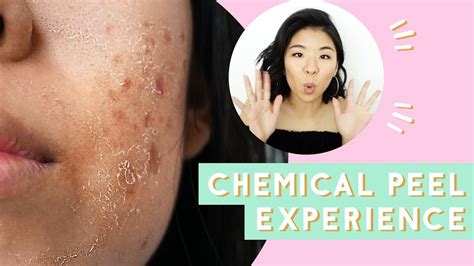 Medium peels treat acne and light scarring as they penetrate deeper into skin than superficial peels. Chemical Peel for Acne & Scars: Before & After - YouTube