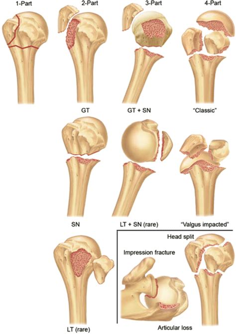 Anatomy And Classification Of Proximal Humerus Fractures SpringerLink