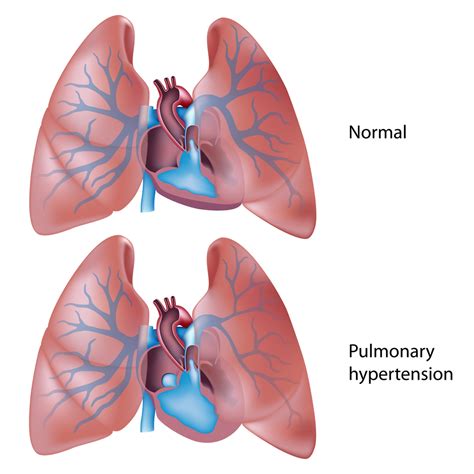 Tuberculosis (tb) is caused by bacteria (mycobacterium tuberculosis) that most often affect the lungs. » Check Out Proposed ICD-10 Cardiology Changes for 2016