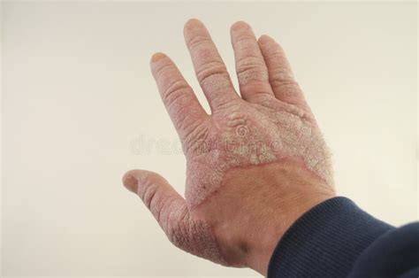 Psoriasis Gemein Pilzartig Ekzem Auf Finger Hautausschlag