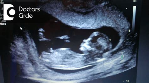 What Does Nt Mean On Baby Scan When And Why To Get Ultrasounds During