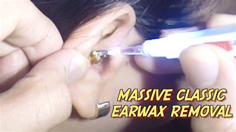 Massive Classic Earwax Removal Youtube
