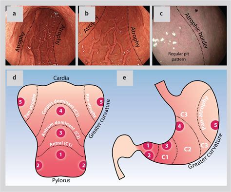 Mistakes In The Management Of Gastric Polyps And How To Avoid Them UEG United European