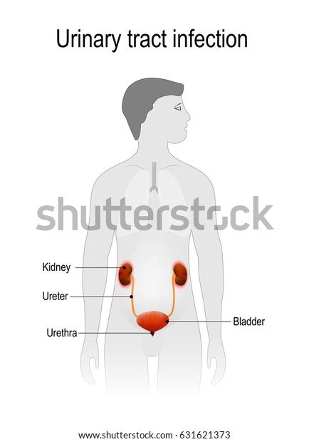 Urinary Tract Infection Pyelonephritis Bladder Kidneys Stock Vector Royalty Free