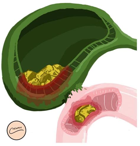 Biliary Colic And Cholecystitis Teachmesurgery