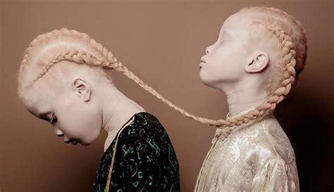 Albinism Beauty