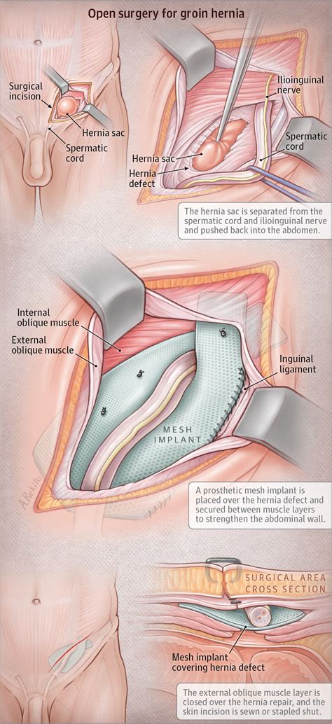 Stages Of Inguinal Hernia Images And Photos Finder