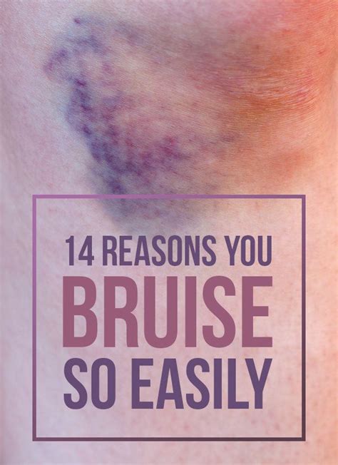 Heres Why You Actually Bruise So Easily Health Falling Down And Massage