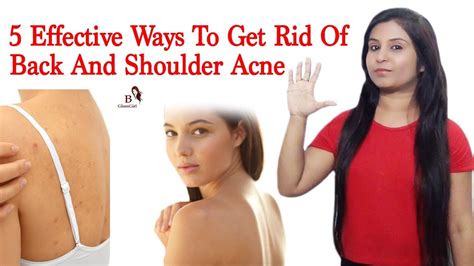 5 Effective Ways To Get Rid Of Back And Shoulder Acne 100 Effective