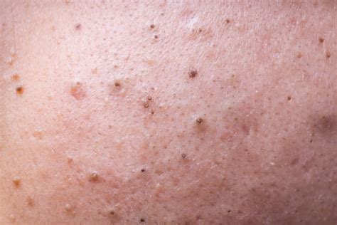 25 Most Satisfying Blackhead Popping Videos From Dr Lee—aka Dr Pimple