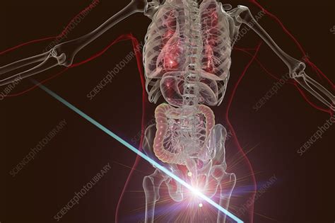 Laser Treatment Of Haemorrhoids Conceptual Illustration Stock Image