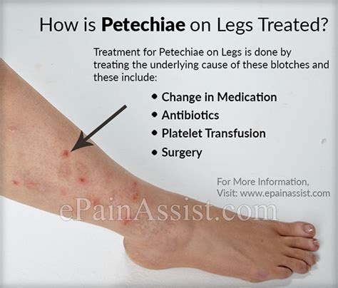 What Causes Petechiae On Legs And How Is It Treated