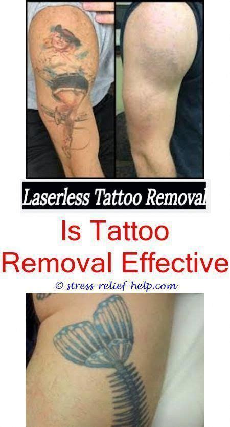 Tattoo Removal Near Me Does Laser Completely Remove Tattoo Laser