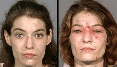 Crystal Meth Before And After Celebrities