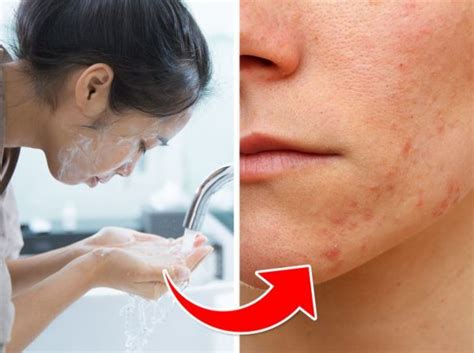 5 Skincare Mistakes That Can Cause Acne Women Daily Magazine