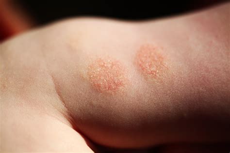 Eczema And Atopic Dermatitis Rashes Causes Symptoms