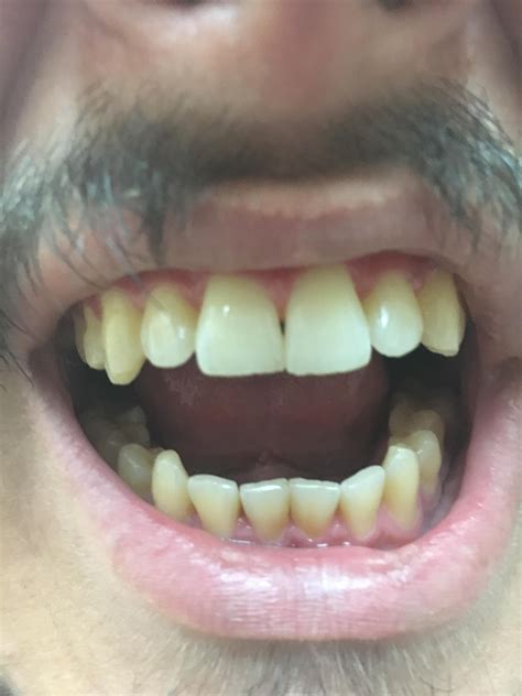 How Bad Are My Black Triangles Dentistry