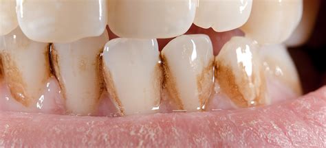 Possible Reasons For Stained Or Dis Colored Teeth Monash Dental Group