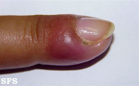 Paronychia is a bacterial or fungal infection that develops on or around the nail bed. Paronychia - wikidoc