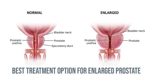 Best Treatment Options For Enlarged Prostate YouTube