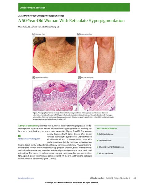 A 50 Year Old Woman With Reticulate Hyperpigmentation Dermatology