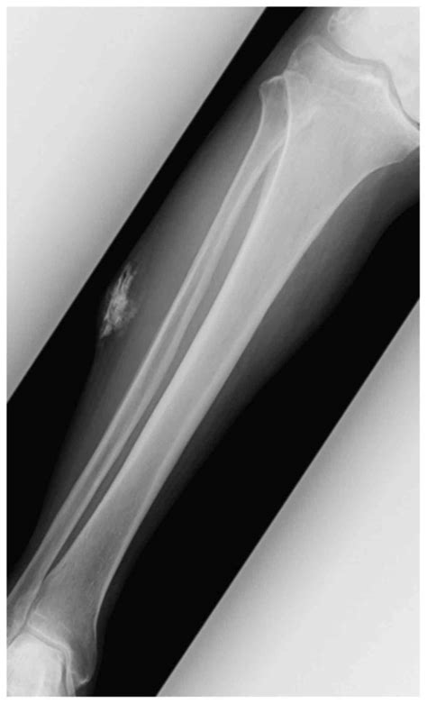 Extraskeletal Osteosarcoma Arising In The Subcutaneous Tissue Of The