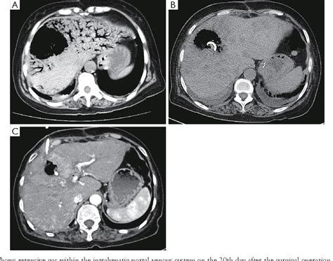 Figure 1 From Hepatic Portal Venous Gas After Radical
