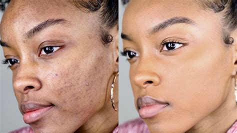 How To Cover Acnedark Spots Without A Lot Of Makeup Slim Reshae
