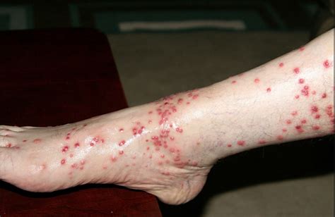 Top 15 Of Chiggers In Bed Sheets Rapsodettan