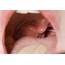 Inflamed Tonsil  Stock Image M270/0315 Science Photo Library