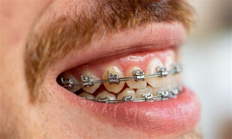 How Tooth Decay And Fillings Affect Braces Newpark Orthodontics