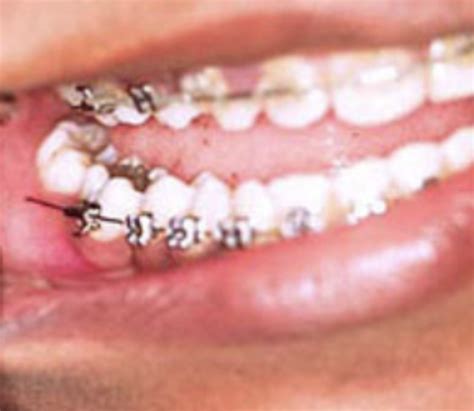 Braces Emergencies Break Your Permanent Retainer Firouz Orthodontic