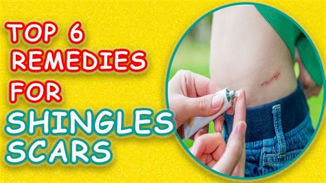 Shingles Scars Removal Naturally Home Remedies You Should Try Youtube