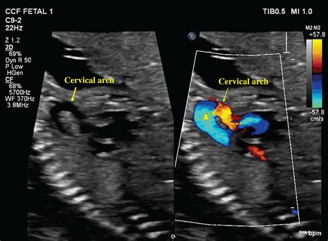 Prenatal Diagnosis Of Right‐sided Cervical Aortic Arch With Aberrant